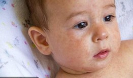 吃伏儿瓜孩子过敏,警惕孩子食用伏儿瓜引发的过敏反应